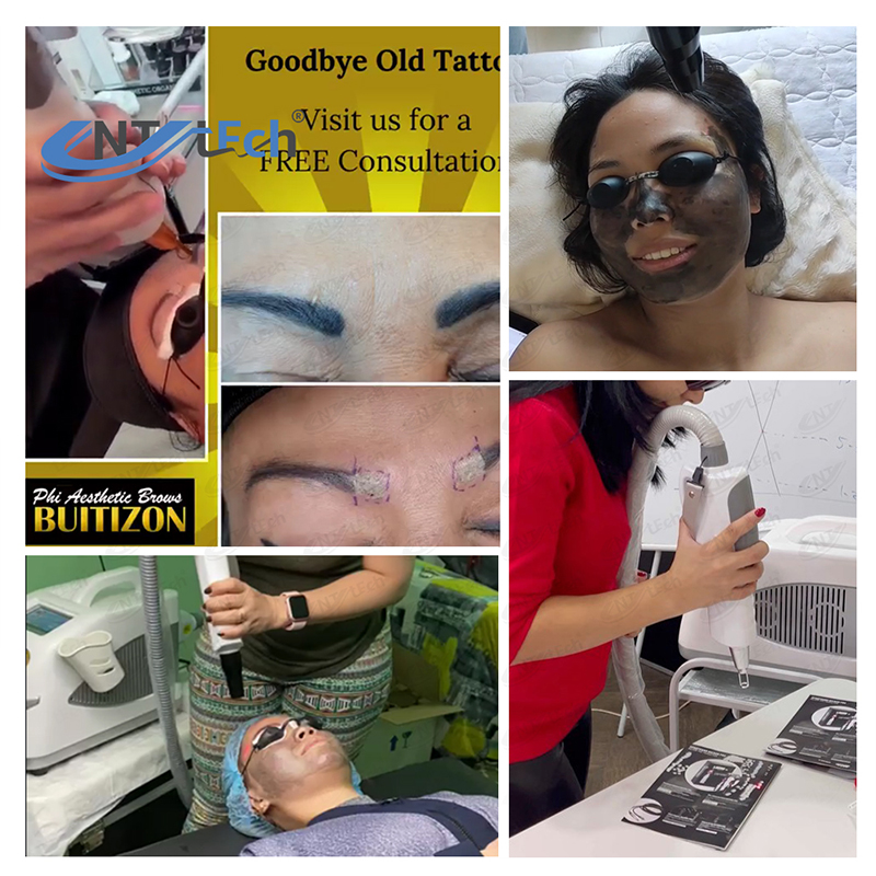 Nd Yag Laser Tattoo Removal Carbon Peel Hollywood Laser Machine