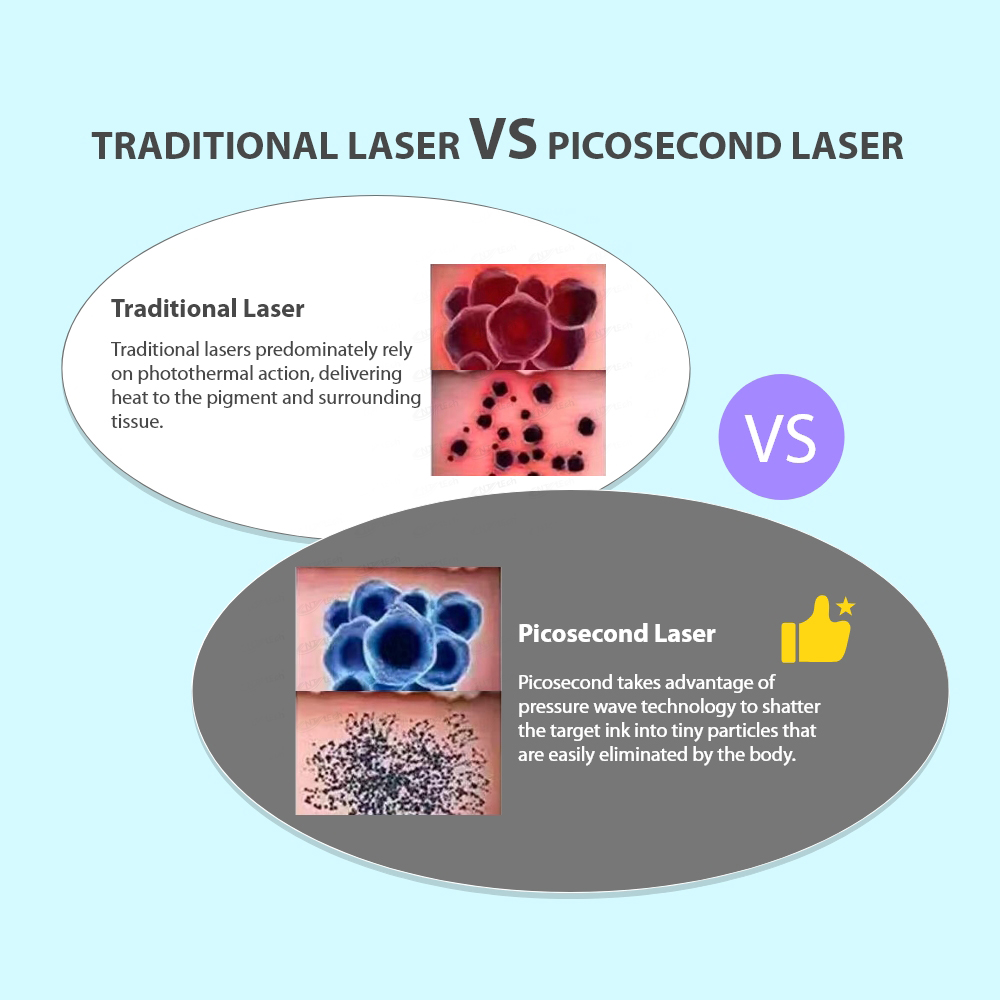 Traditional Laser VS Pico laser – 1