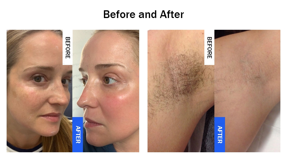 Before and After of IPL Hair Removal 
